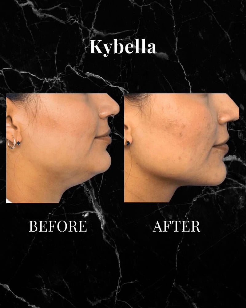 Kybella Before and After