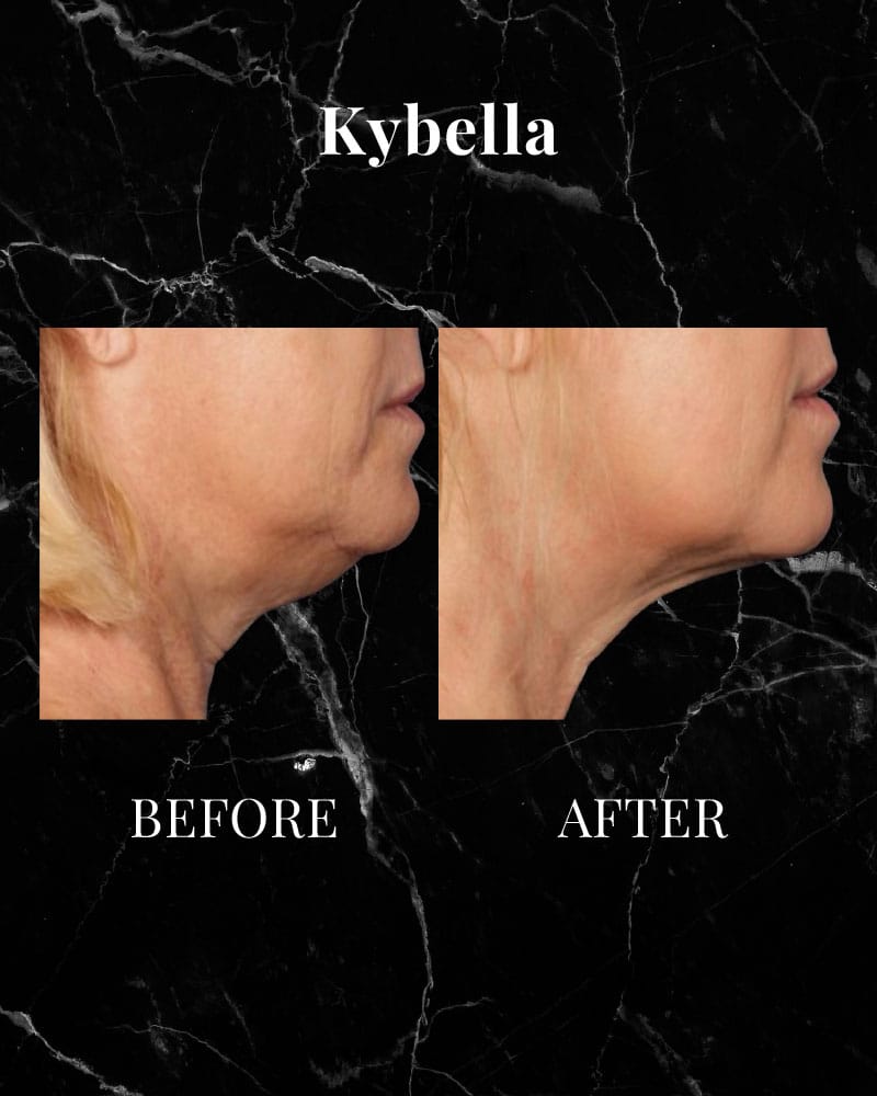 Kybella Before and After