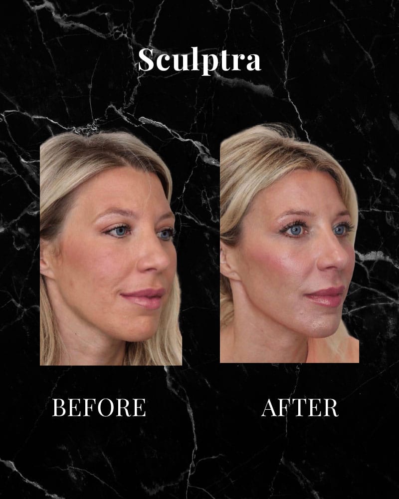 Sculptra Before and After