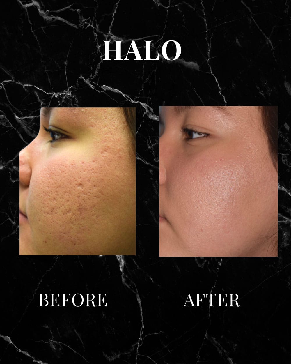 HALO before and after results
