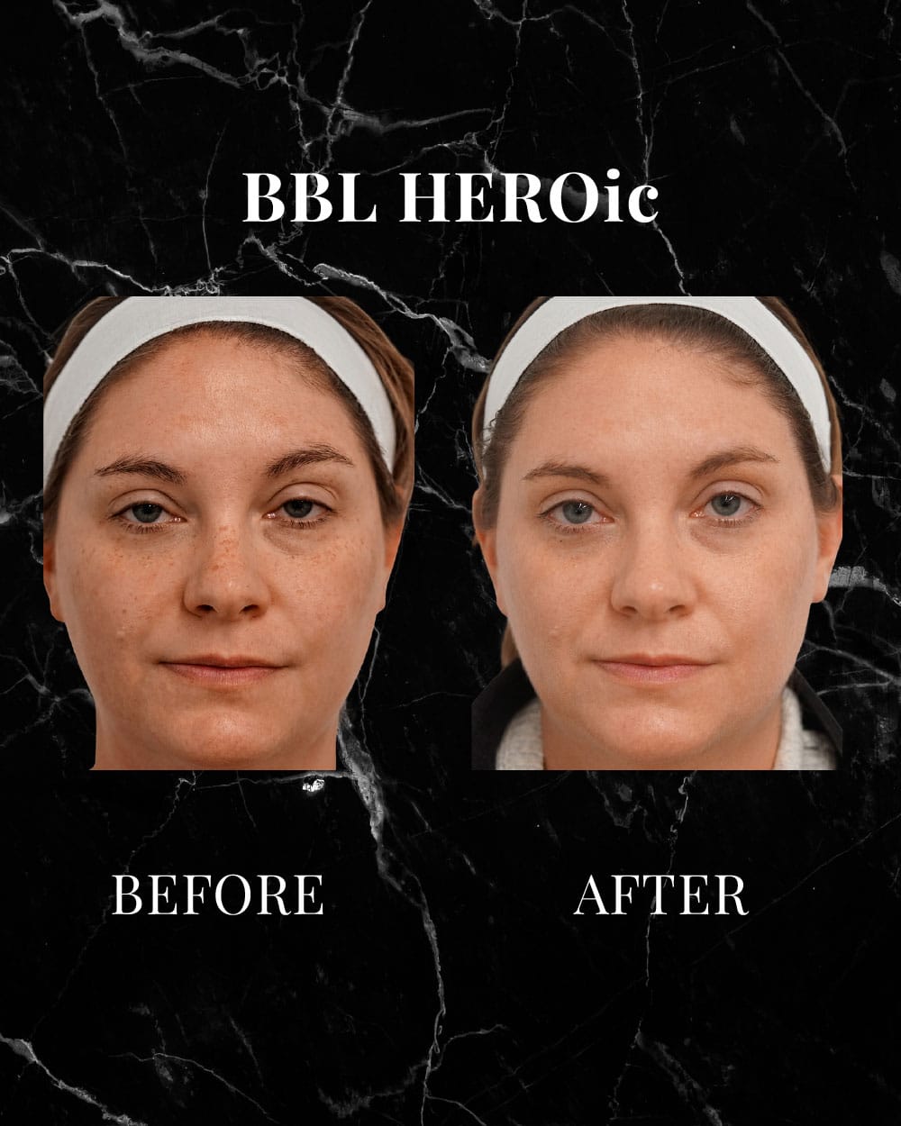 BBL HEROic before and after results
