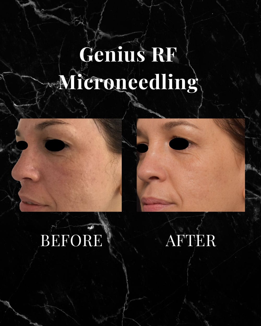 Genius RF Microneedling before and after results