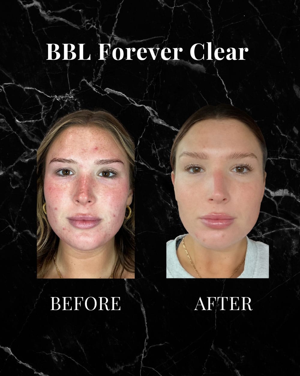 BBL Forever Clear before and after results