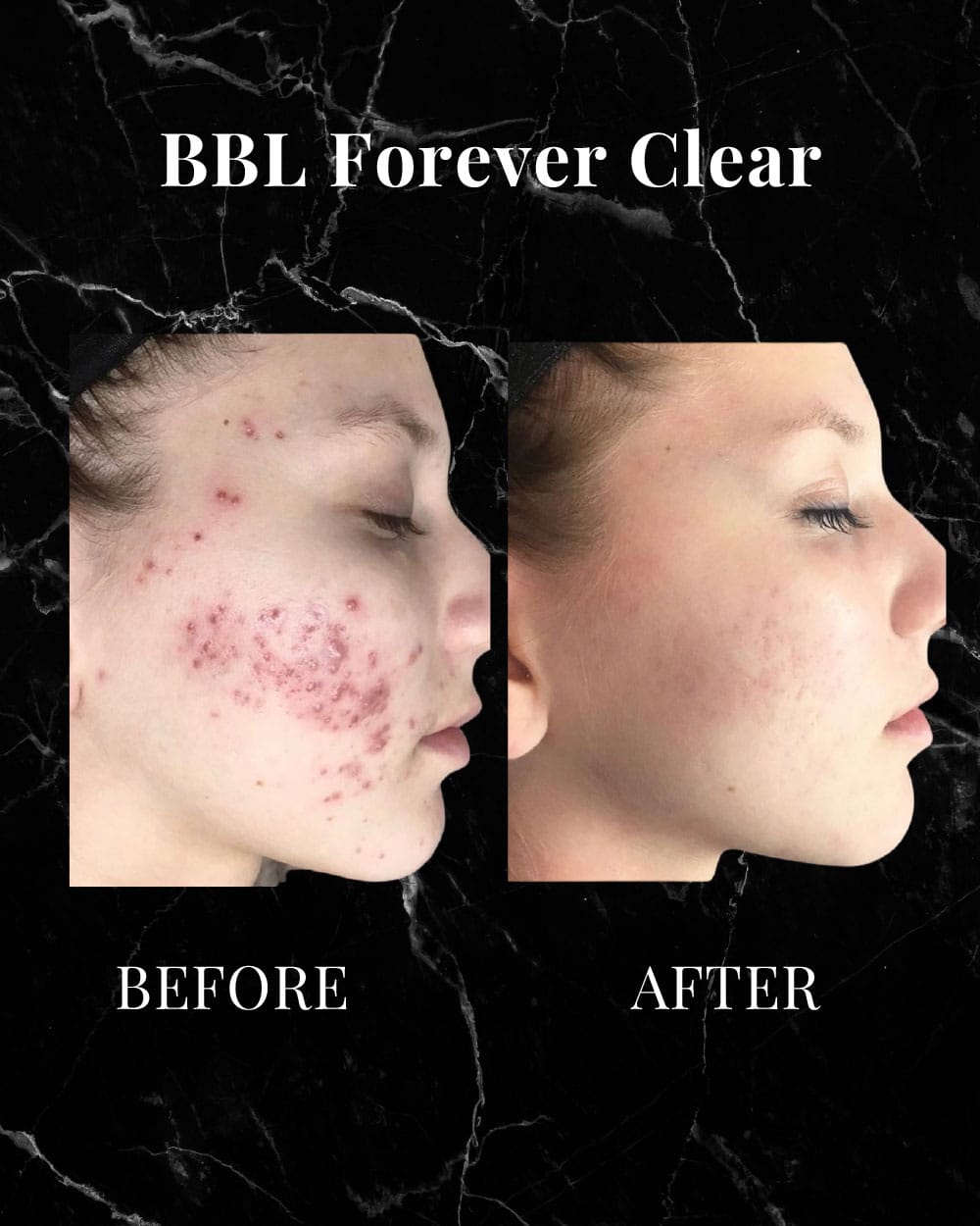 BBL Forever Clear before and after results