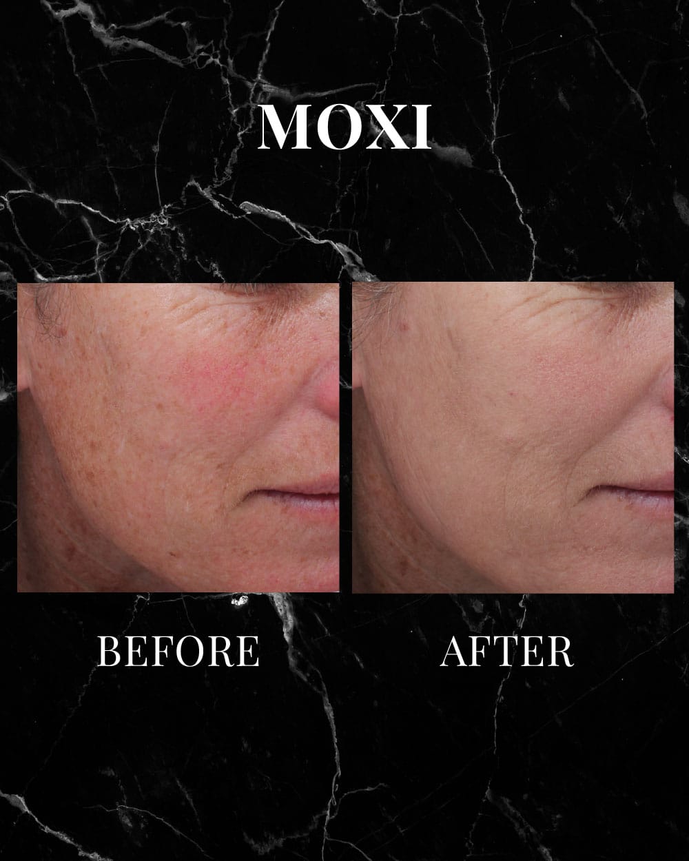 MOXI before and after results