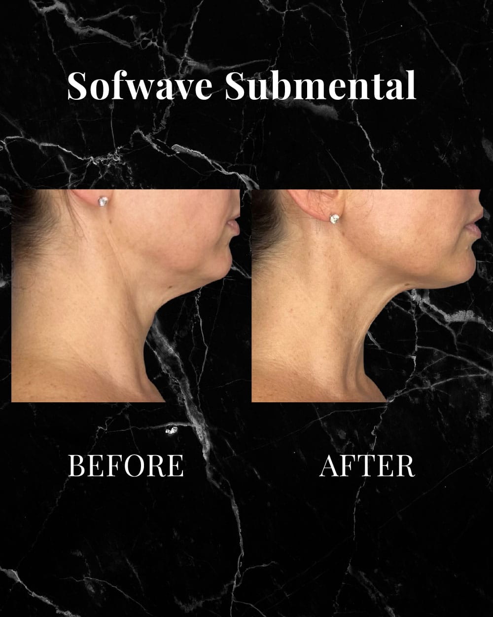 Sofwave before and after results