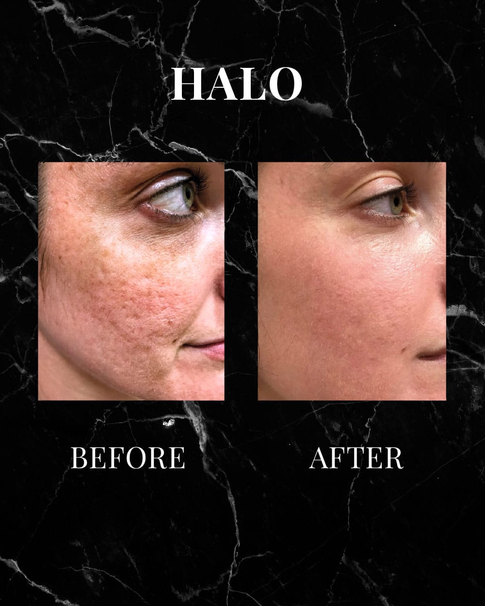 HALO before and after results