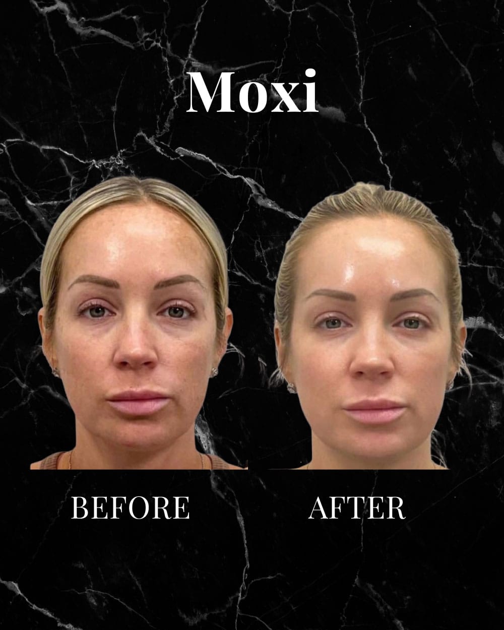 MOXI before and after results